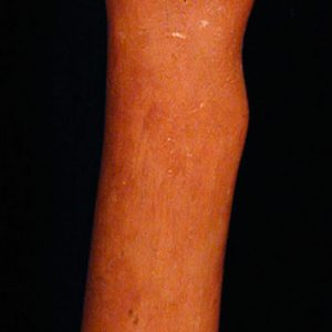 Milagré arm ex-voto